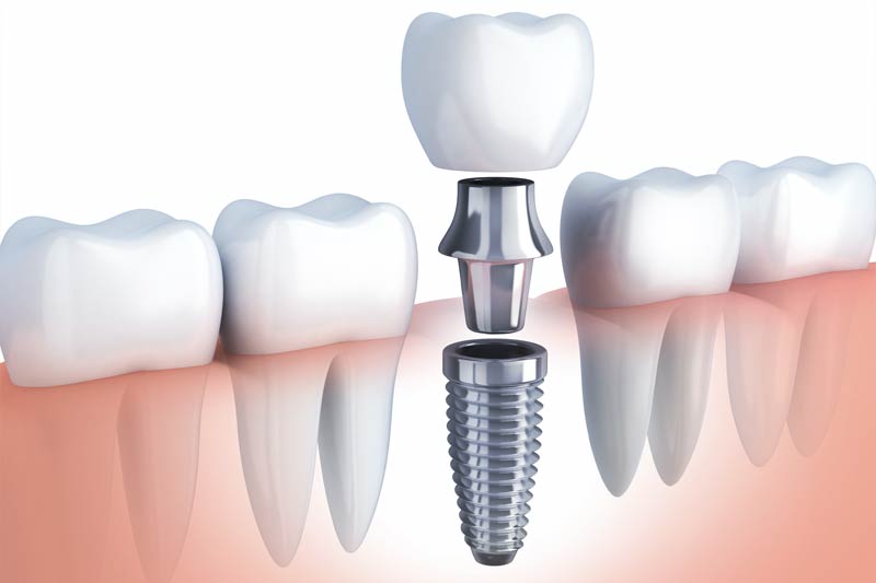 Implants Dentist in Gambrills